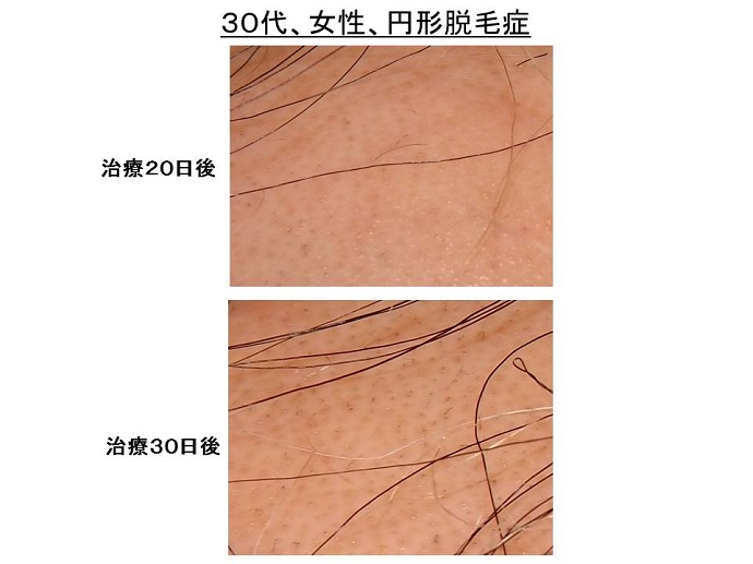 円形脱毛症　病院""